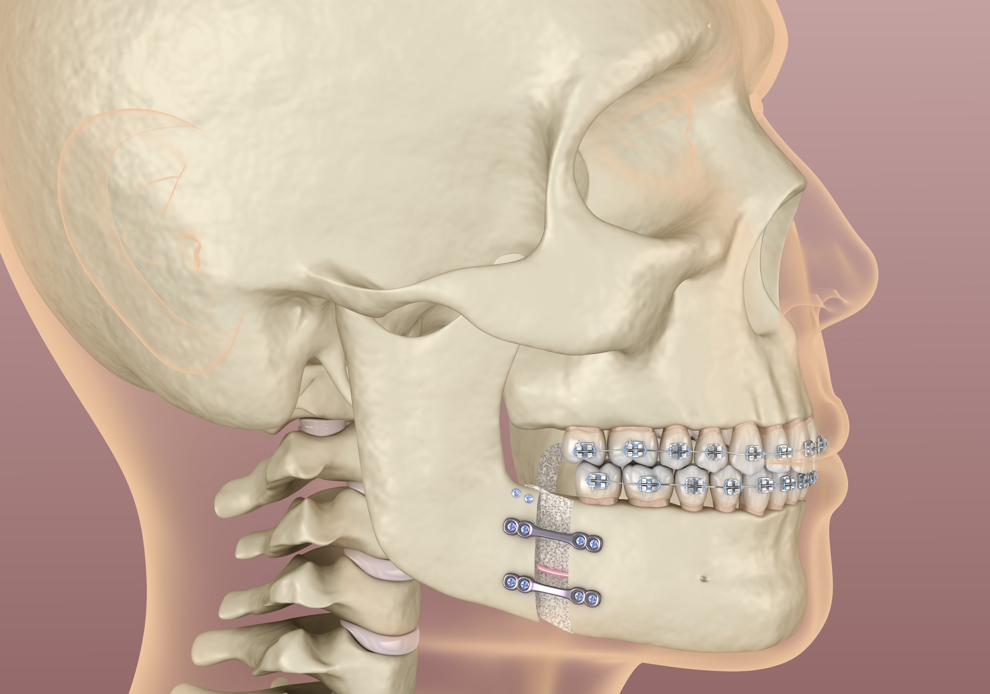 Orthognathic Surgery