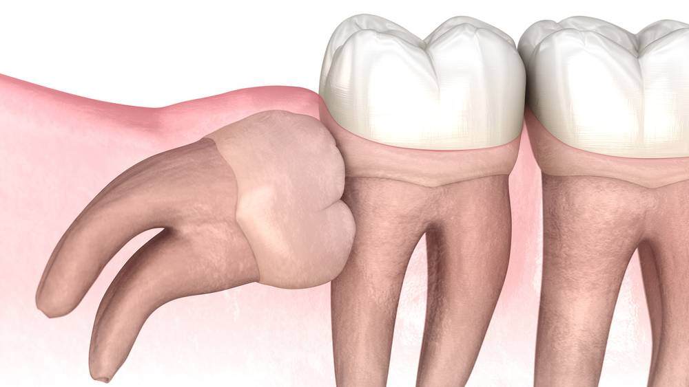 impacted-wisdom-tooth