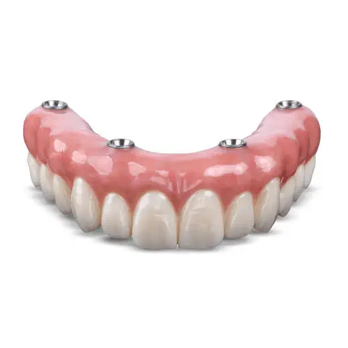 implant retained dentures