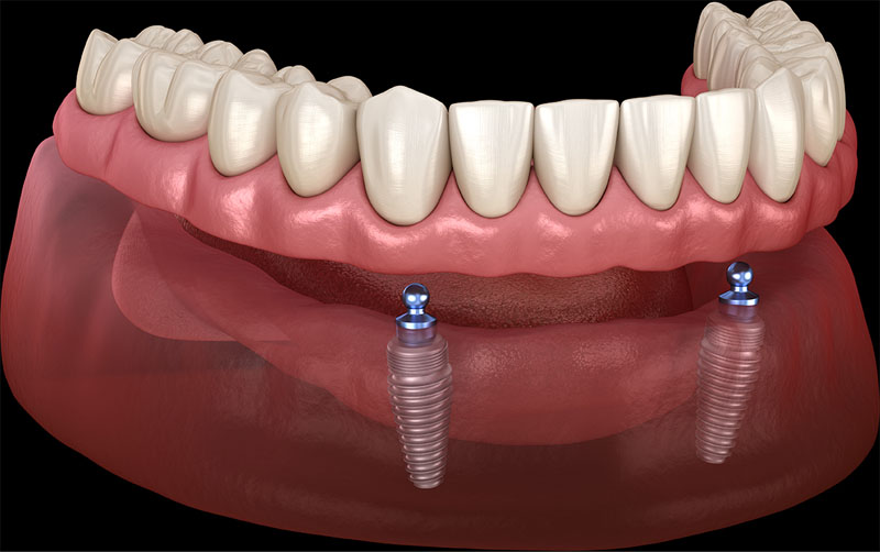 implant supported dentures