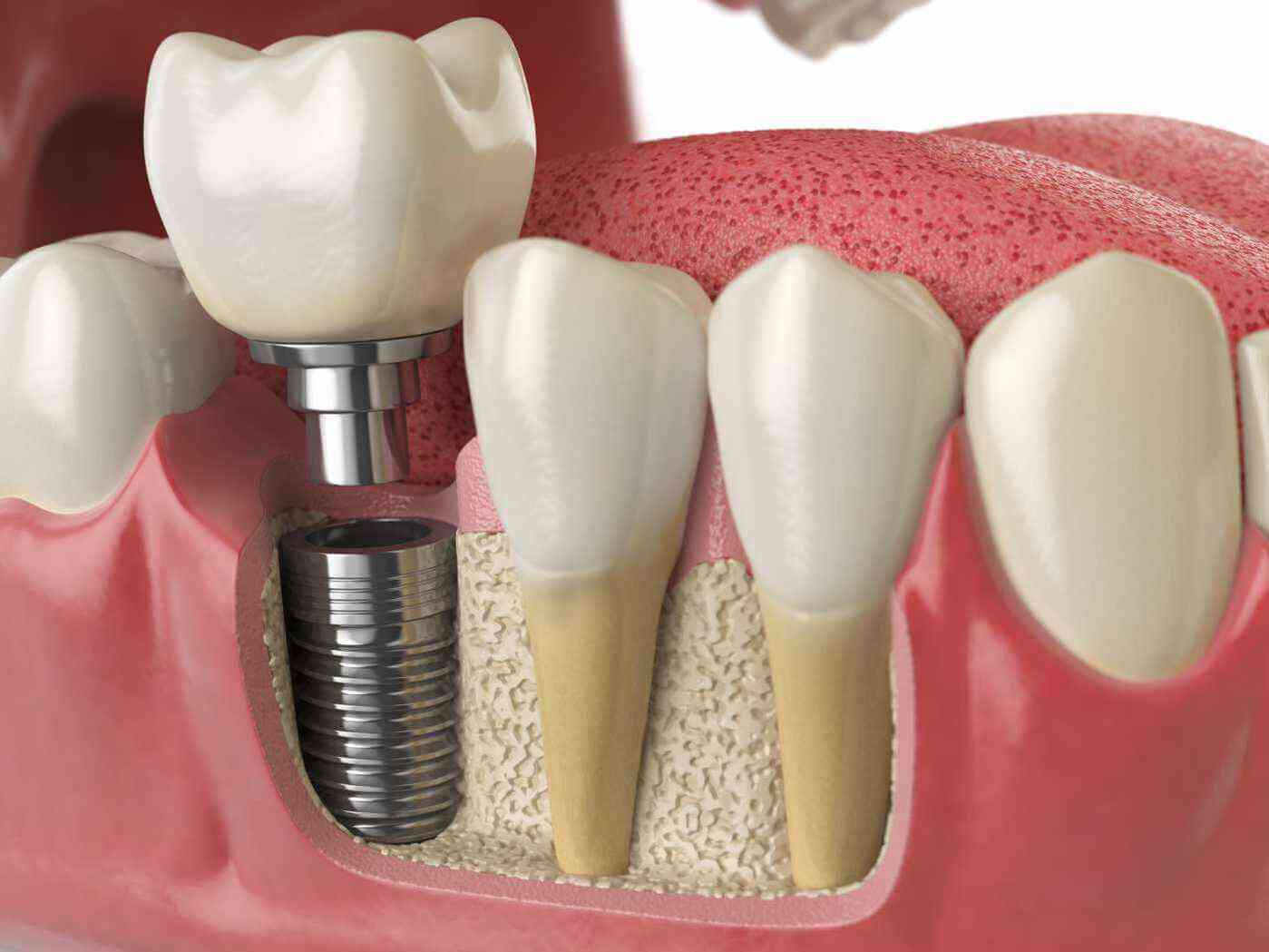 anatomy-of-healthy-teeth-and-tooth-dental-implant-P5PWYZQ (1)-1