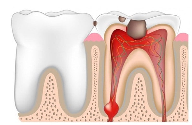 pulpitis